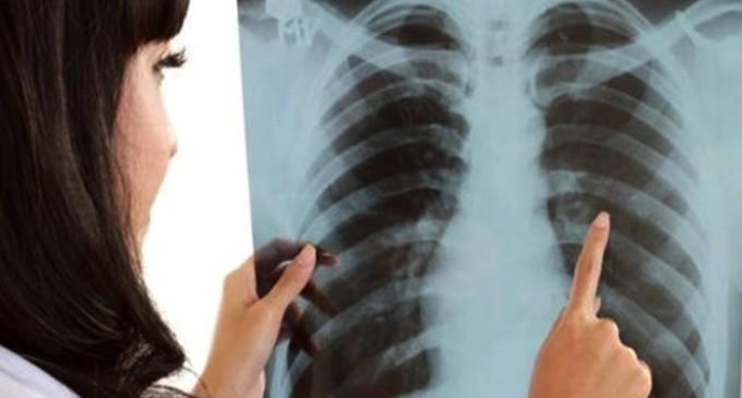 Santarém inicia nesta quarta (20) a Semana de Combate a Tuberculose Santarém inicia nesta quarta (20) a Semana de Combate a Tuberculose