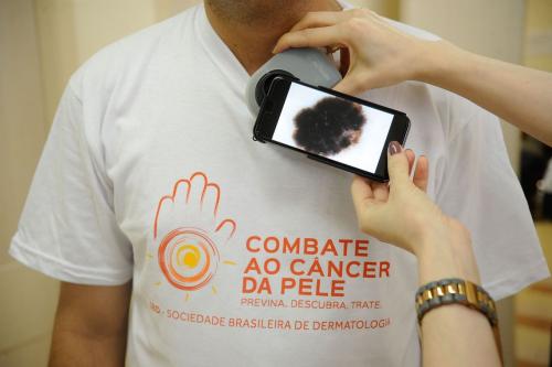 Mutirão fará diagnóstico precoce de câncer de pele em todo o país Mutirão fará diagnóstico precoce de câncer de pele em todo o país